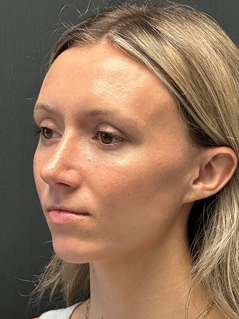 Rhinoplasty Before & After Gallery - Patient 122921815 - Image 4
