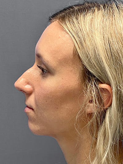 Primary Rhinoplasty Before & After Gallery - Patient 122921815 - Image 1