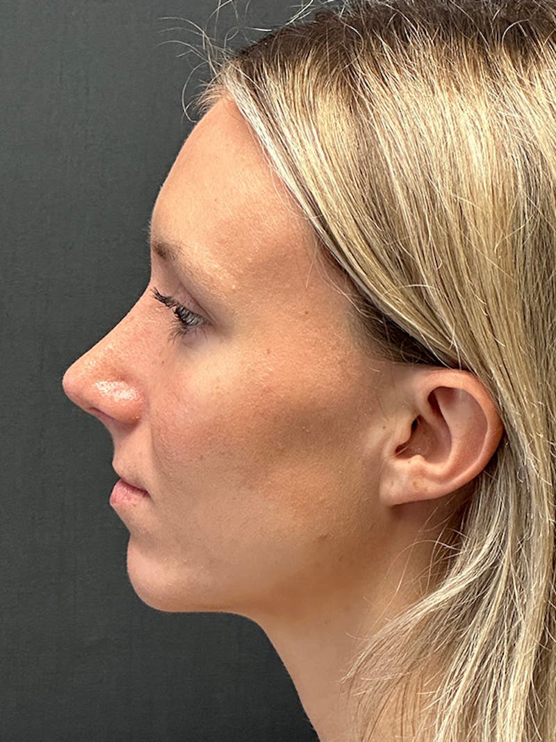 Rhinoplasty Before & After Gallery - Patient 122921815 - Image 6