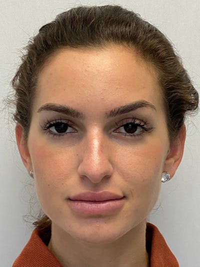 Primary Rhinoplasty Before & After Gallery - Patient 122921848 - Image 1