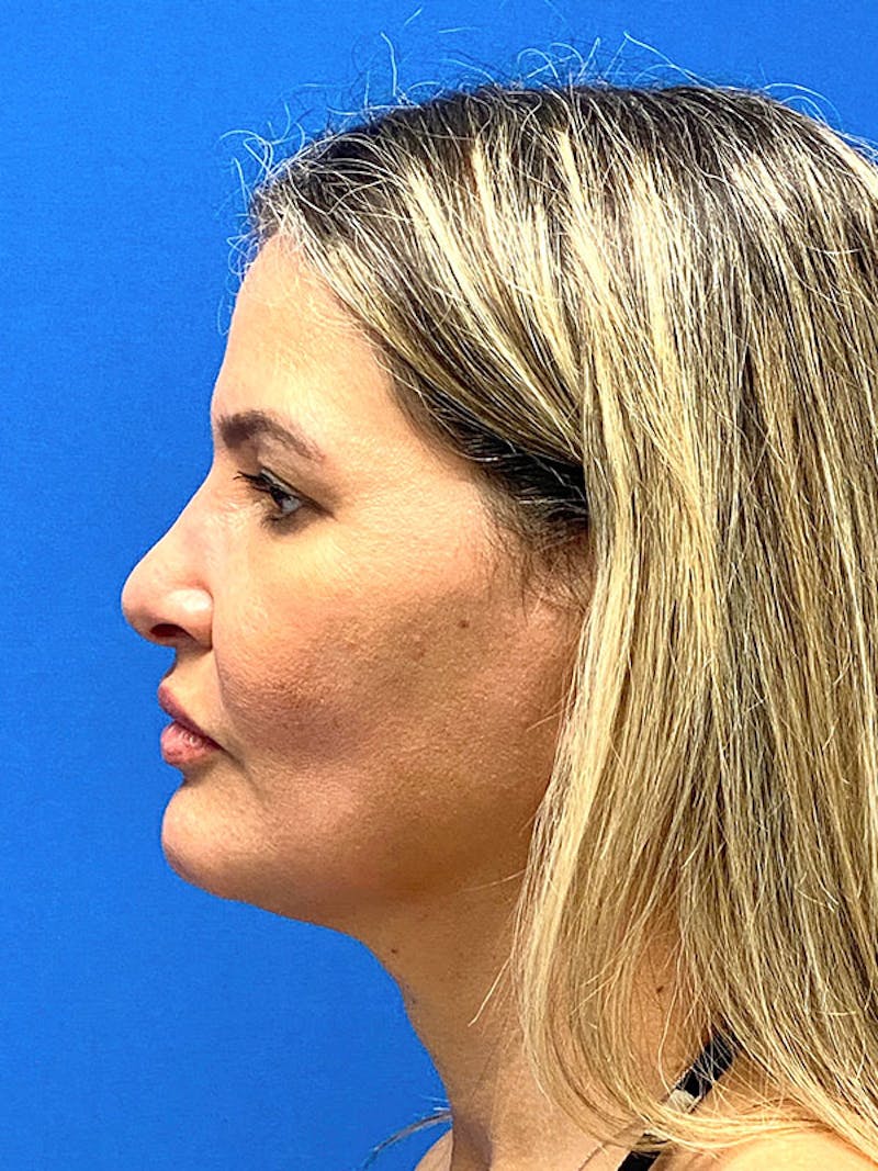 Revision Rhinoplasty Before & After Gallery - Patient 122921834 - Image 5