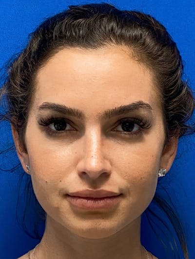 Primary Rhinoplasty Before & After Gallery - Patient 122921848 - Image 2