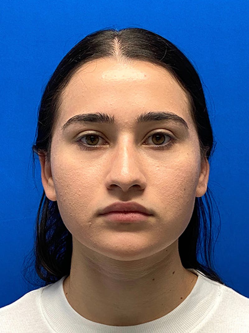 Revision Rhinoplasty Before & After Gallery - Patient 122921852 - Image 1