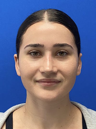 Revision Rhinoplasty Before & After Gallery - Patient 122921852 - Image 2