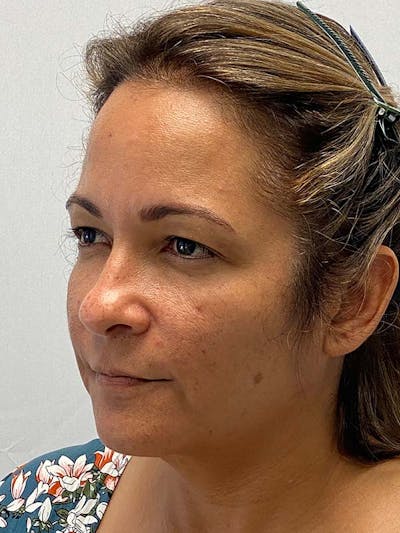 Neck Lift Before & After Gallery - Patient 122921851 - Image 1