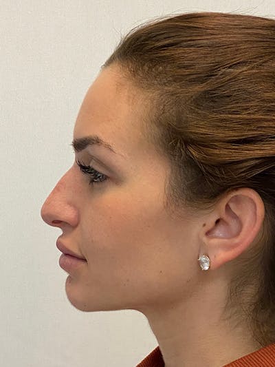 Primary Rhinoplasty Before & After Gallery - Patient 122921848 - Image 1
