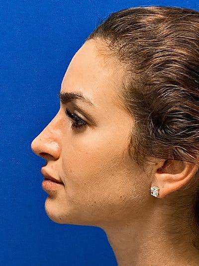 Primary Rhinoplasty Before & After Gallery - Patient 122921848 - Image 2