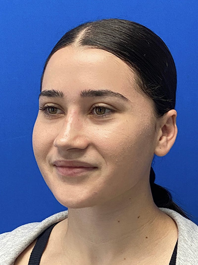 Revision Rhinoplasty Before & After Gallery - Patient 122921852 - Image 4