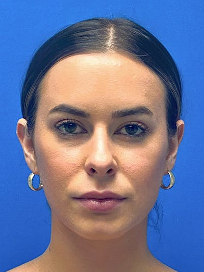Primary Rhinoplasty Before & After Gallery - Patient 122921873 - Image 1
