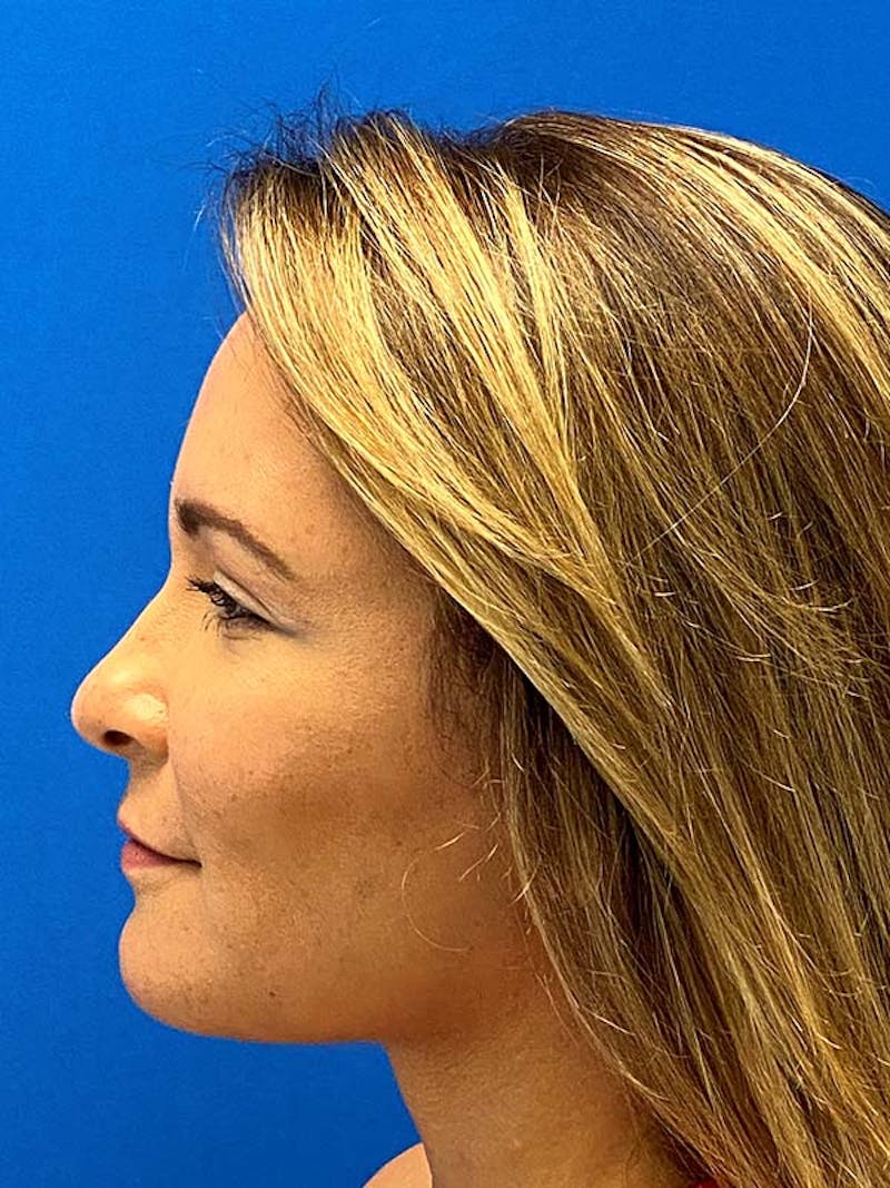 Neck Lift Before & After Gallery - Patient 122921851 - Image 10