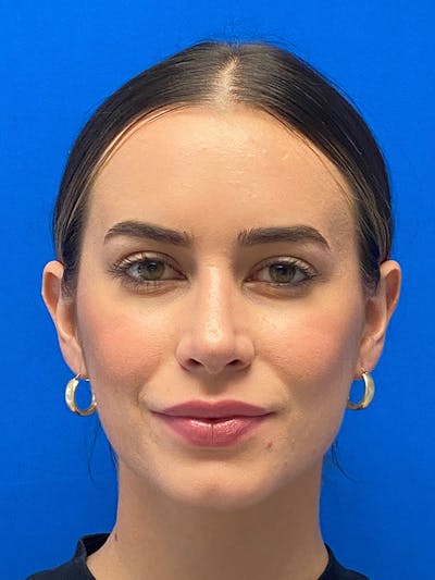 Primary Rhinoplasty Before & After Gallery - Patient 122921873 - Image 2