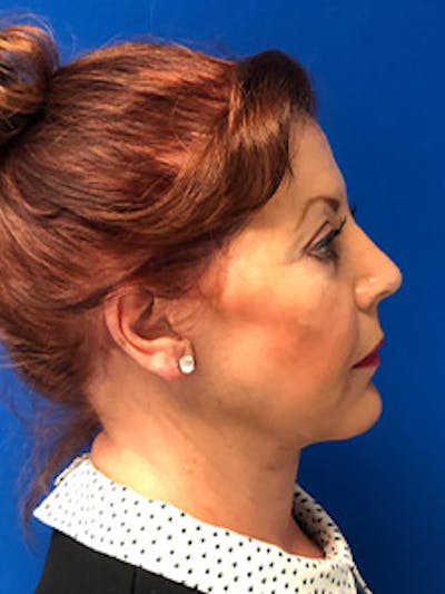 Neck Lift Before & After Gallery - Patient 122921857 - Image 2