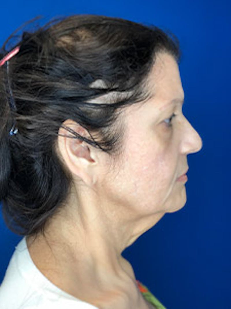 Neck Lift Before & After Gallery - Patient 122921864 - Image 1