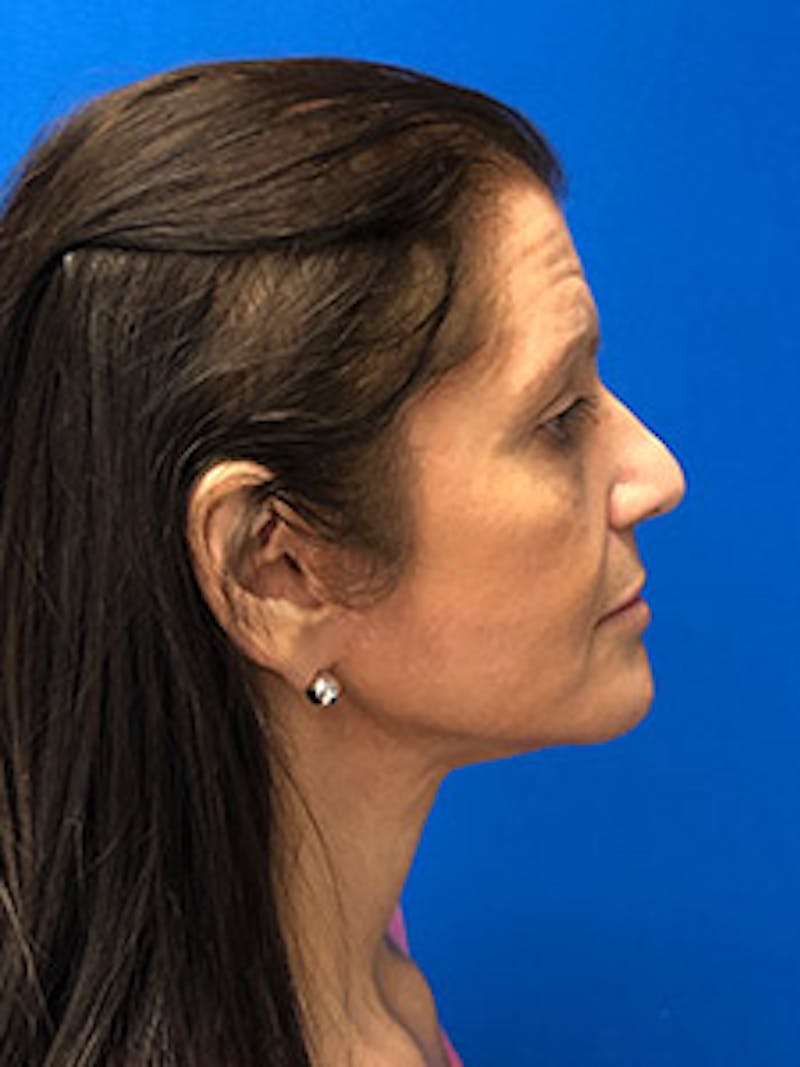 Neck Lift Before & After Gallery - Patient 122921864 - Image 2