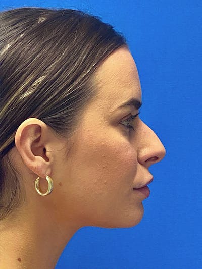 Primary Rhinoplasty Before & After Gallery - Patient 122921873 - Image 1