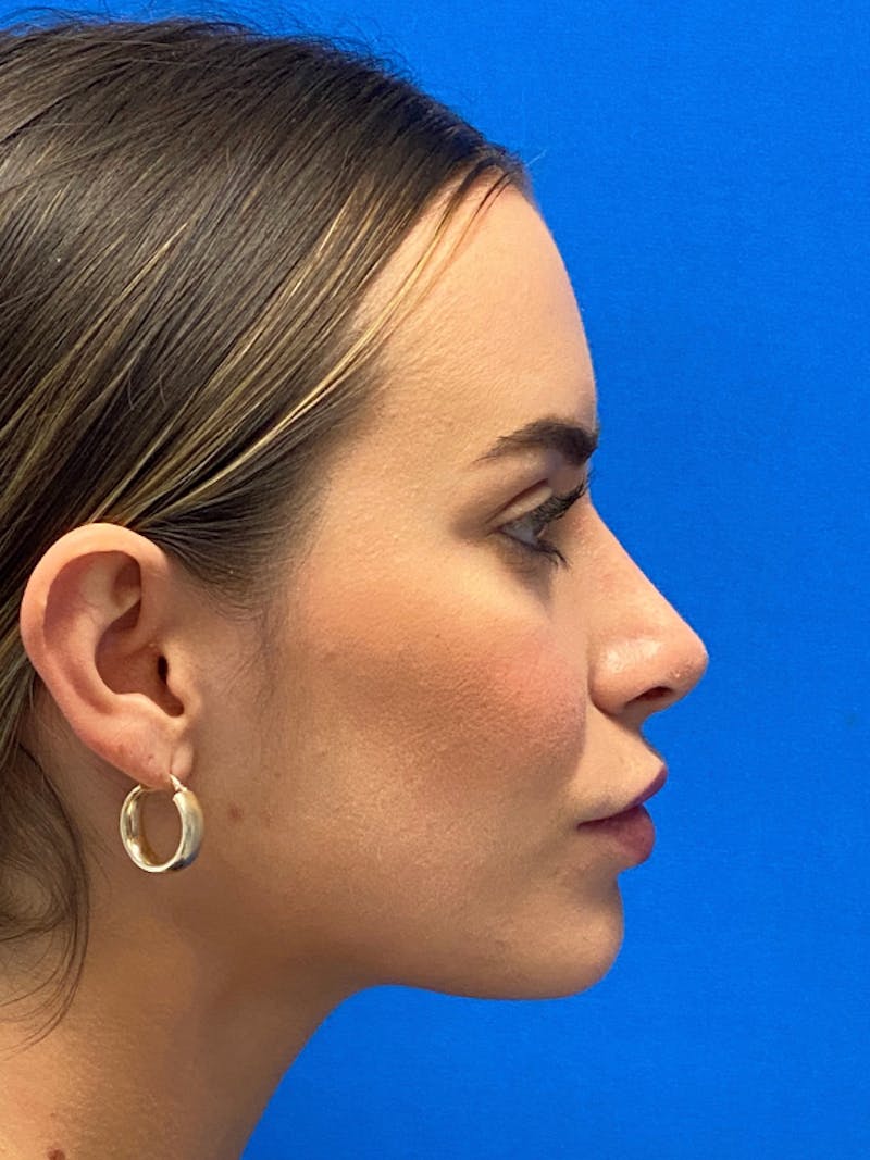 Primary Rhinoplasty Before & After Gallery - Patient 122921873 - Image 6