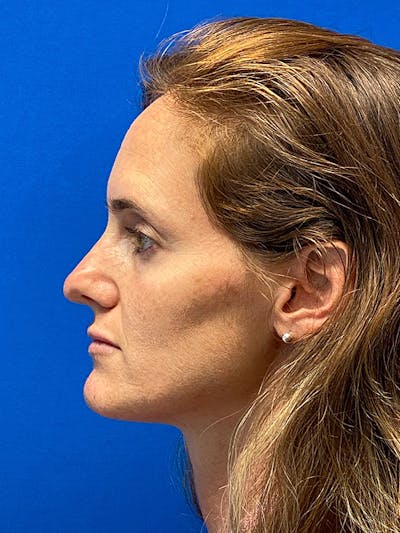 Revision Rhinoplasty Before & After Gallery - Patient 122921879 - Image 1