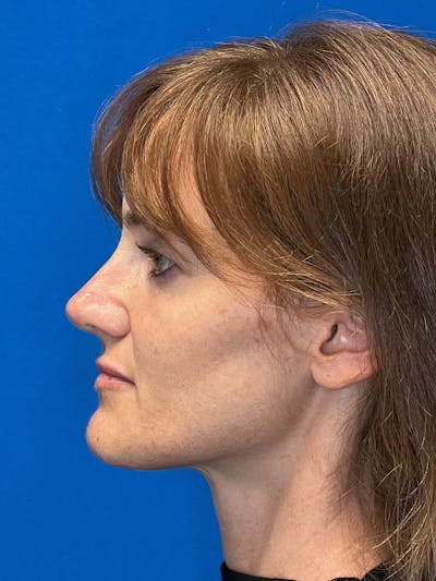 Revision Rhinoplasty Before & After Gallery - Patient 122921879 - Image 2