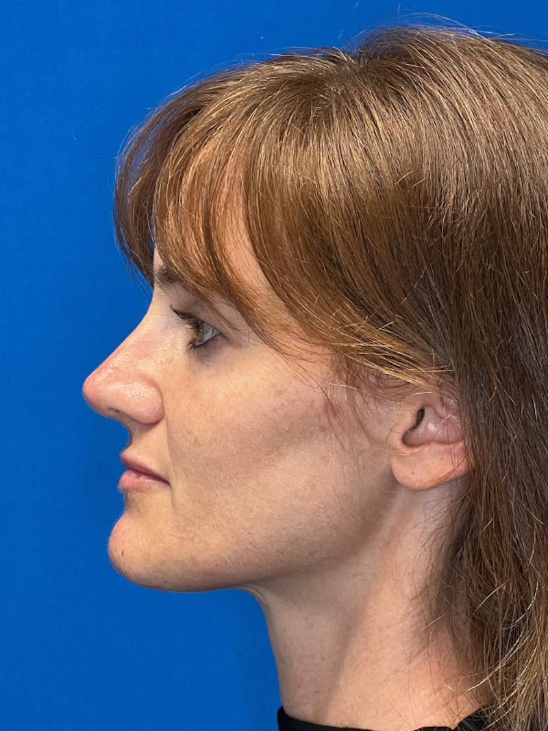 Revision Rhinoplasty Before & After Gallery - Patient 122921879 - Image 6