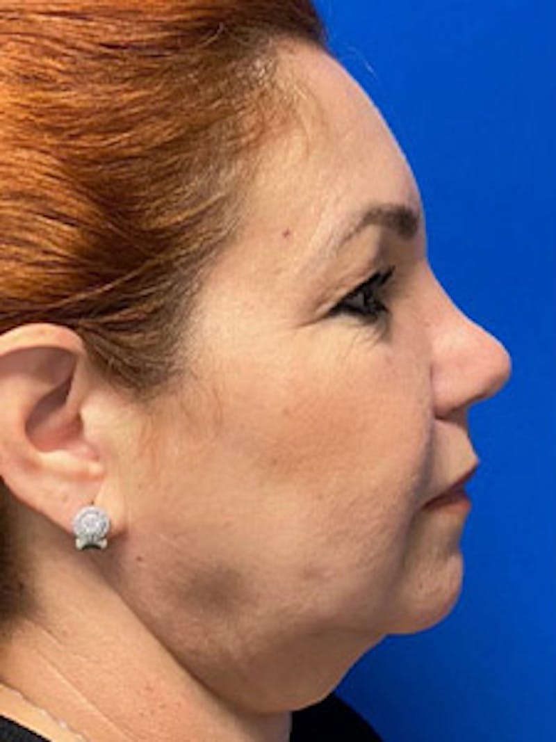 Neck Lift Before & After Gallery - Patient 122921906 - Image 3