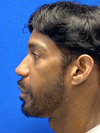 Primary Rhinoplasty Before & After Gallery - Patient 122921914 - Image 1