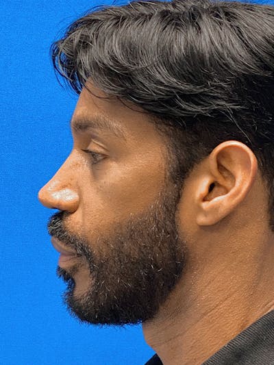 Primary Rhinoplasty Before & After Gallery - Patient 122921914 - Image 2