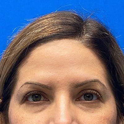 Blepharoplasty Before & After Gallery - Patient 122921956 - Image 1