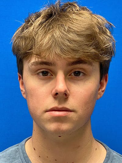 Male Face & Neck Before & After Gallery - Patient 133554864 - Image 1