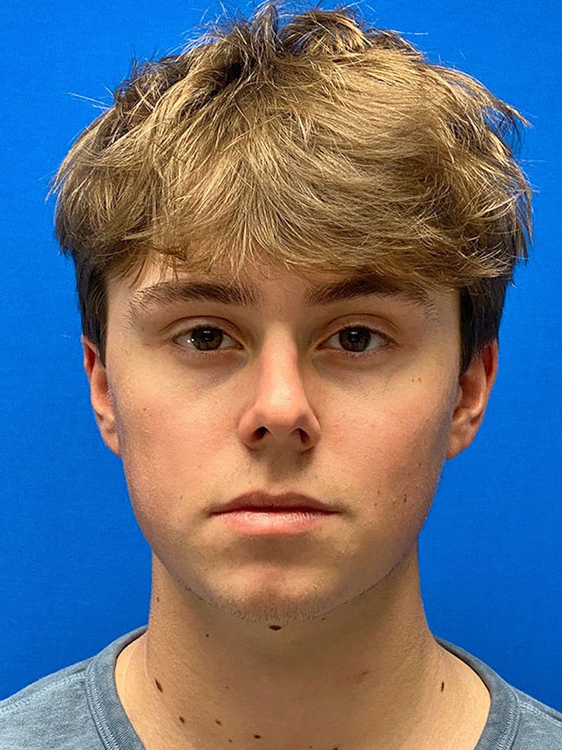 Male Face & Neck Before & After Gallery - Patient 133554864 - Image 1