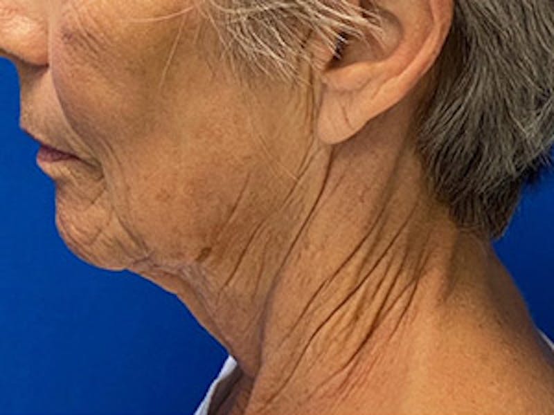 Neck Lift Before & After Gallery - Patient 122921959 - Image 3