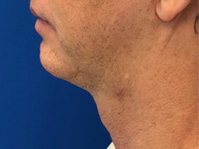 Neck Lift Before & After Gallery - Patient 122921963 - Image 1
