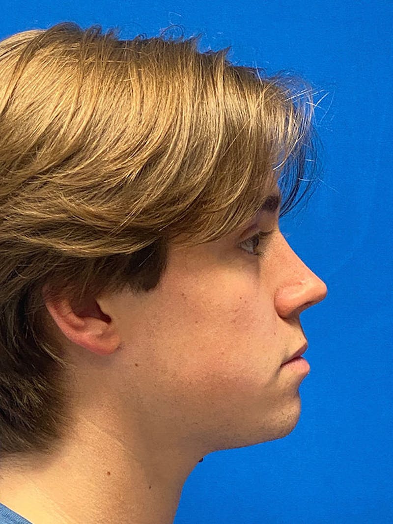 Primary Rhinoplasty Before & After Gallery - Patient 122921969 - Image 6
