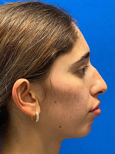 Primary Rhinoplasty Before & After Gallery - Patient 122922016 - Image 1