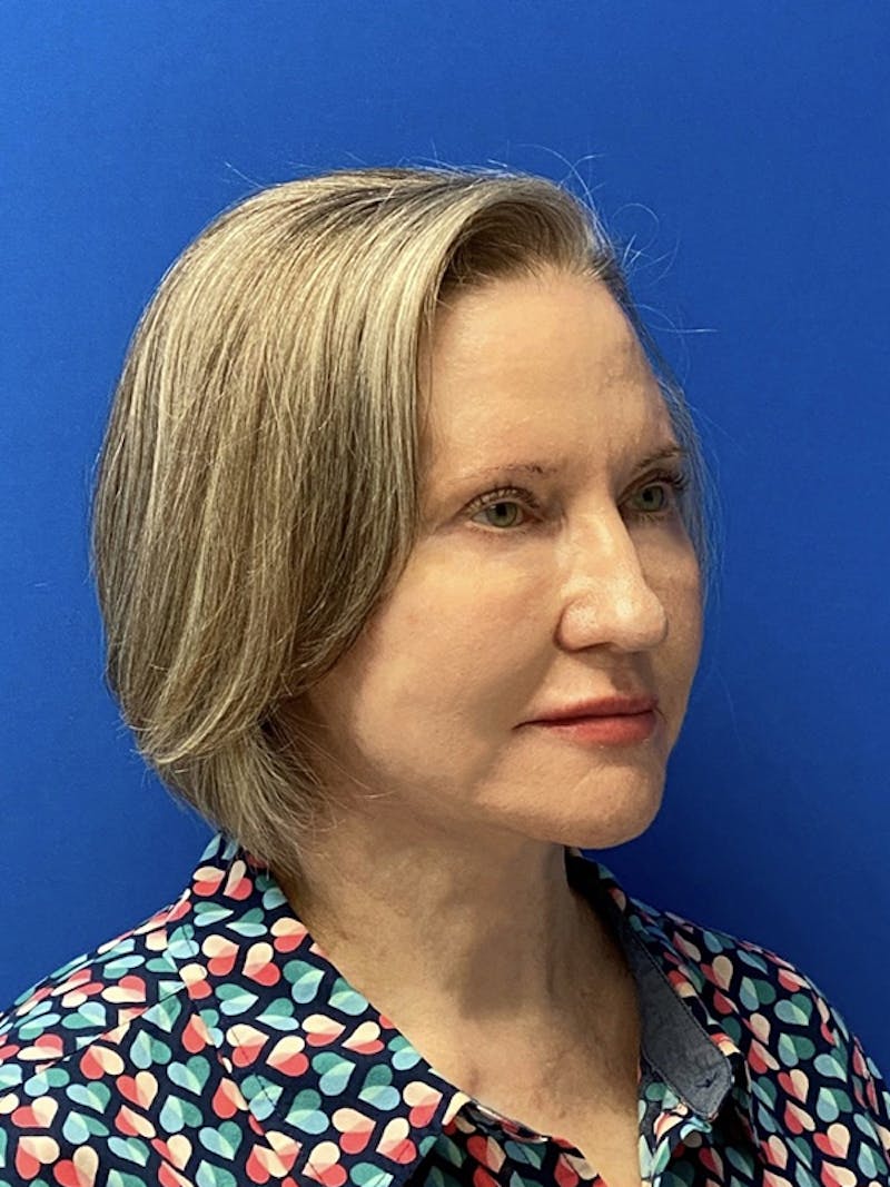 Earlobe Reduction Before & After Gallery - Patient 122922046 - Image 4
