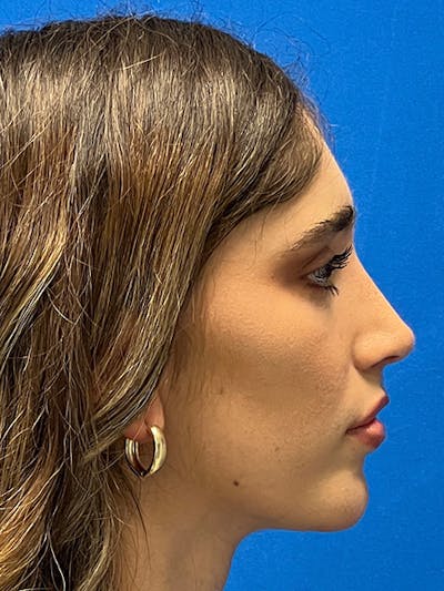 Primary Rhinoplasty Before & After Gallery - Patient 122922016 - Image 2