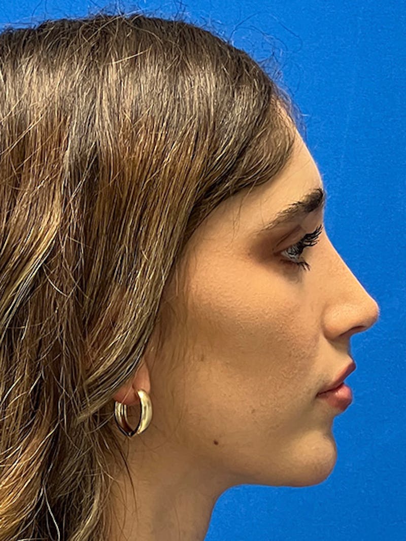 Rhinoplasty Before & After Gallery - Patient 122922016 - Image 6