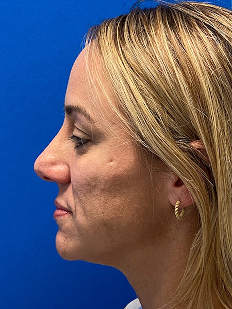 Primary Rhinoplasty Before & After Gallery - Patient 122922135 - Image 3