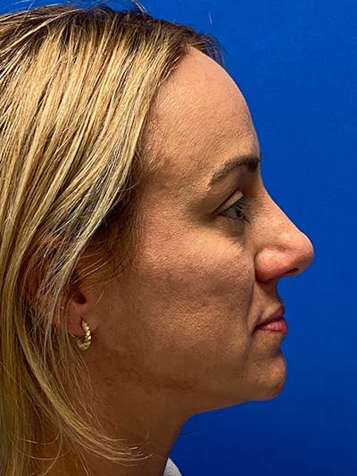 Primary Rhinoplasty Before & After Gallery - Patient 122922135 - Image 1