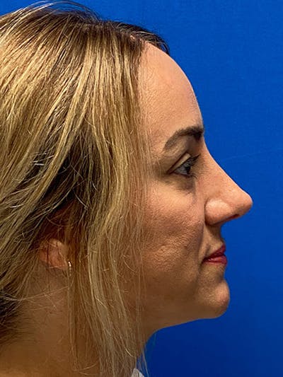 Primary Rhinoplasty Before & After Gallery - Patient 122922135 - Image 2