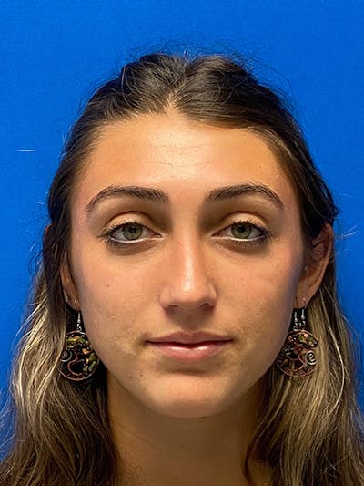 Primary Rhinoplasty Before & After Gallery - Patient 122922198 - Image 2