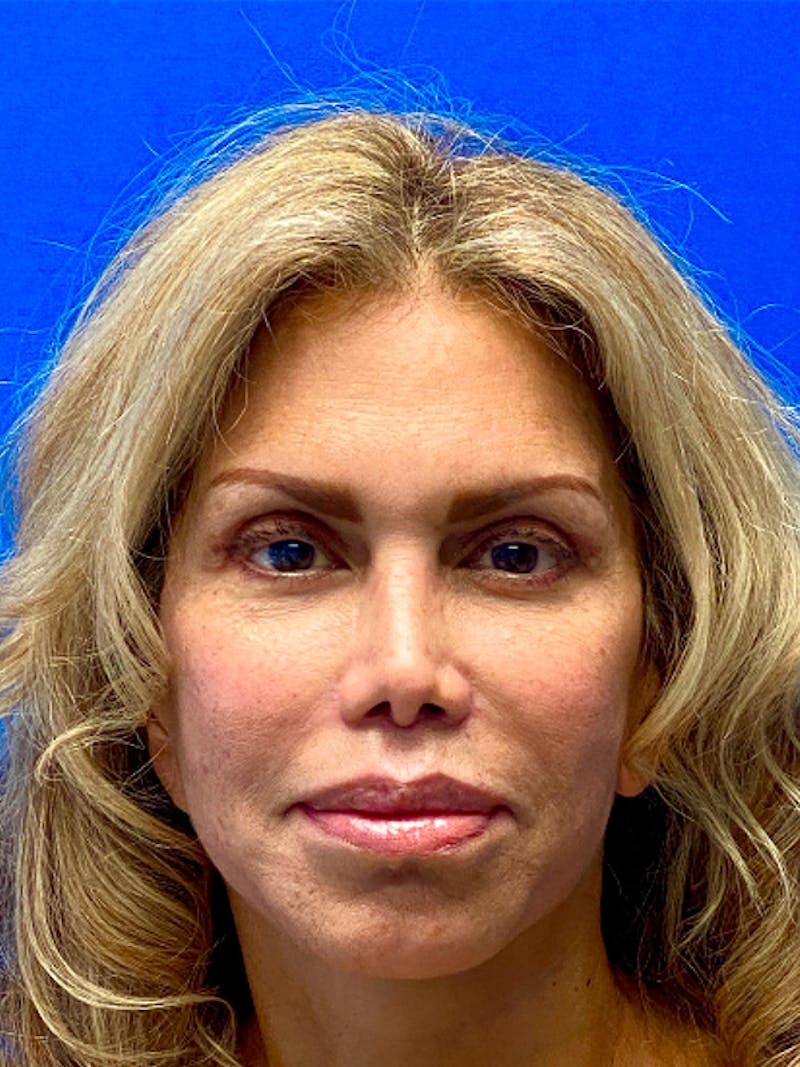 Blepharoplasty Before & After Gallery - Patient 122922188 - Image 2