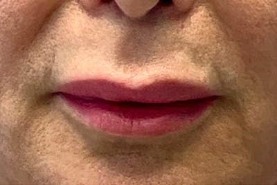 Lip Lift Before & After Gallery - Patient 122922172 - Image 1