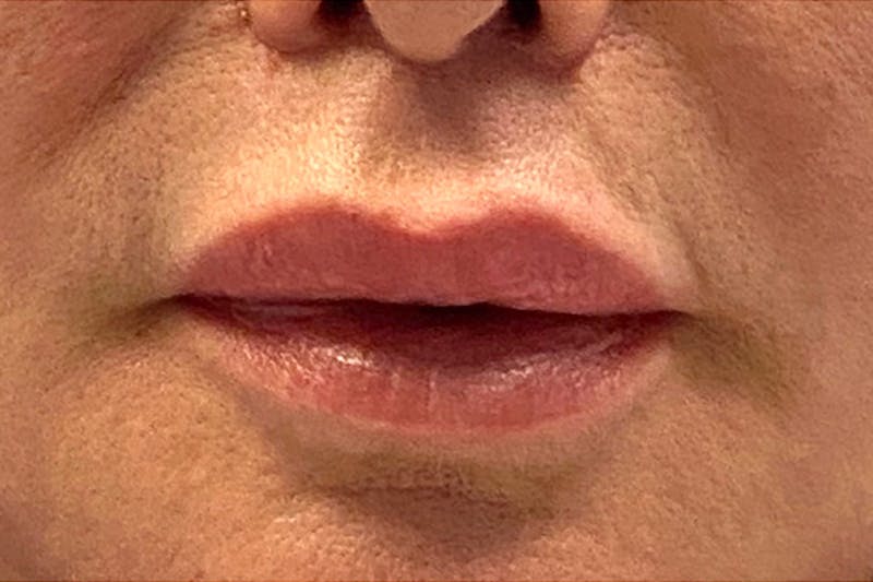Lip Lift Before & After Gallery - Patient 122922172 - Image 2