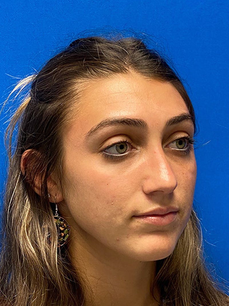 Primary Rhinoplasty Before & After Gallery - Patient 122922198 - Image 4