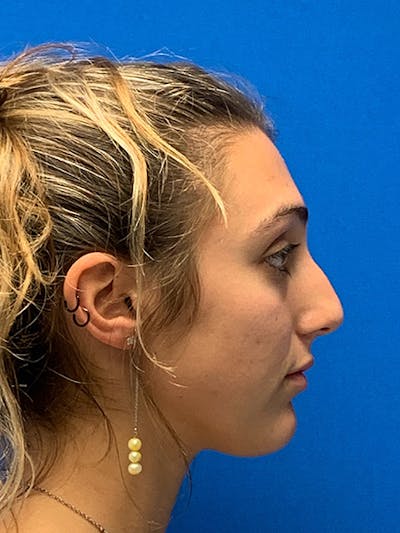 Primary Rhinoplasty Before & After Gallery - Patient 122922198 - Image 1