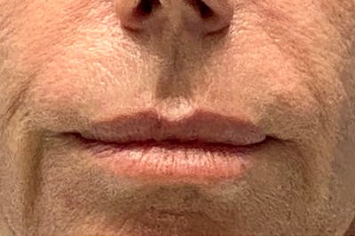 Lip Lift Before & After Gallery - Patient 122922177 - Image 1