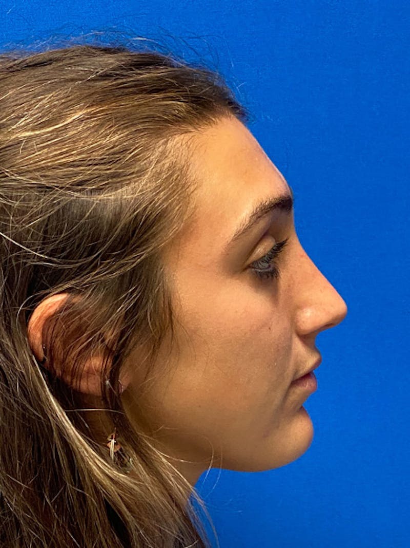 Rhinoplasty Before & After Gallery - Patient 122922198 - Image 6