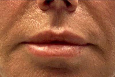 Lip Lift Before & After Gallery - Patient 122922177 - Image 2