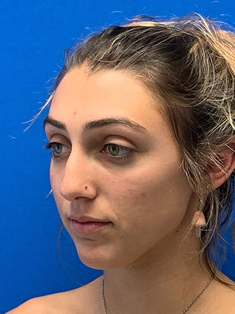 Rhinoplasty Before & After Gallery - Patient 122922198 - Image 7