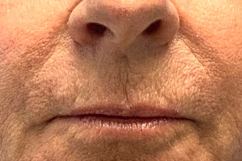 Lip Lift Before & After Gallery - Patient 122922191 - Image 1